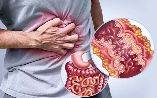 Crohn’s Disease/Ulcerative Colitis